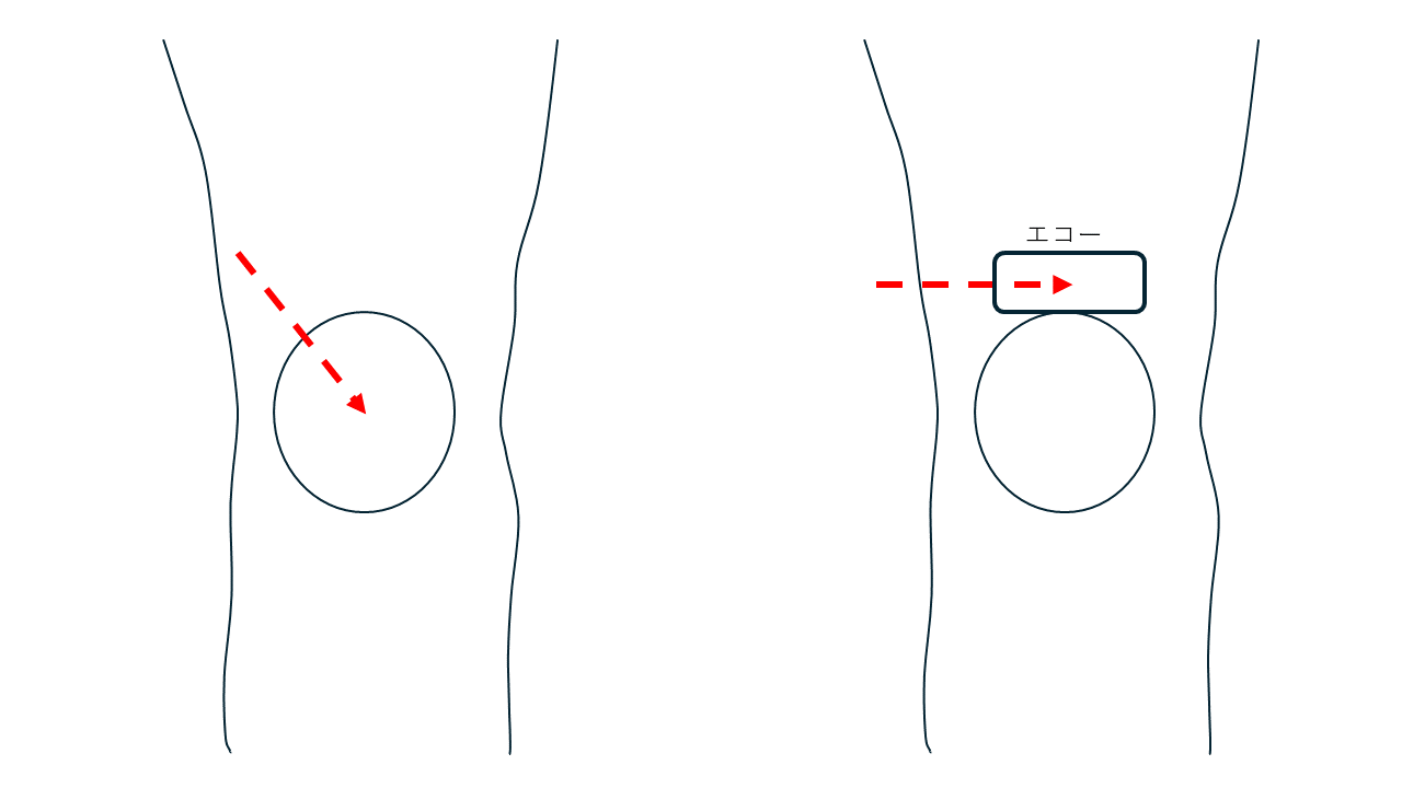 膝関節穿刺の図