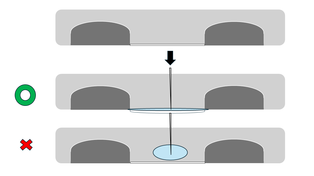 肋間神経ブロックの図